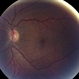Talc Retinopathy Talc Retinopathy